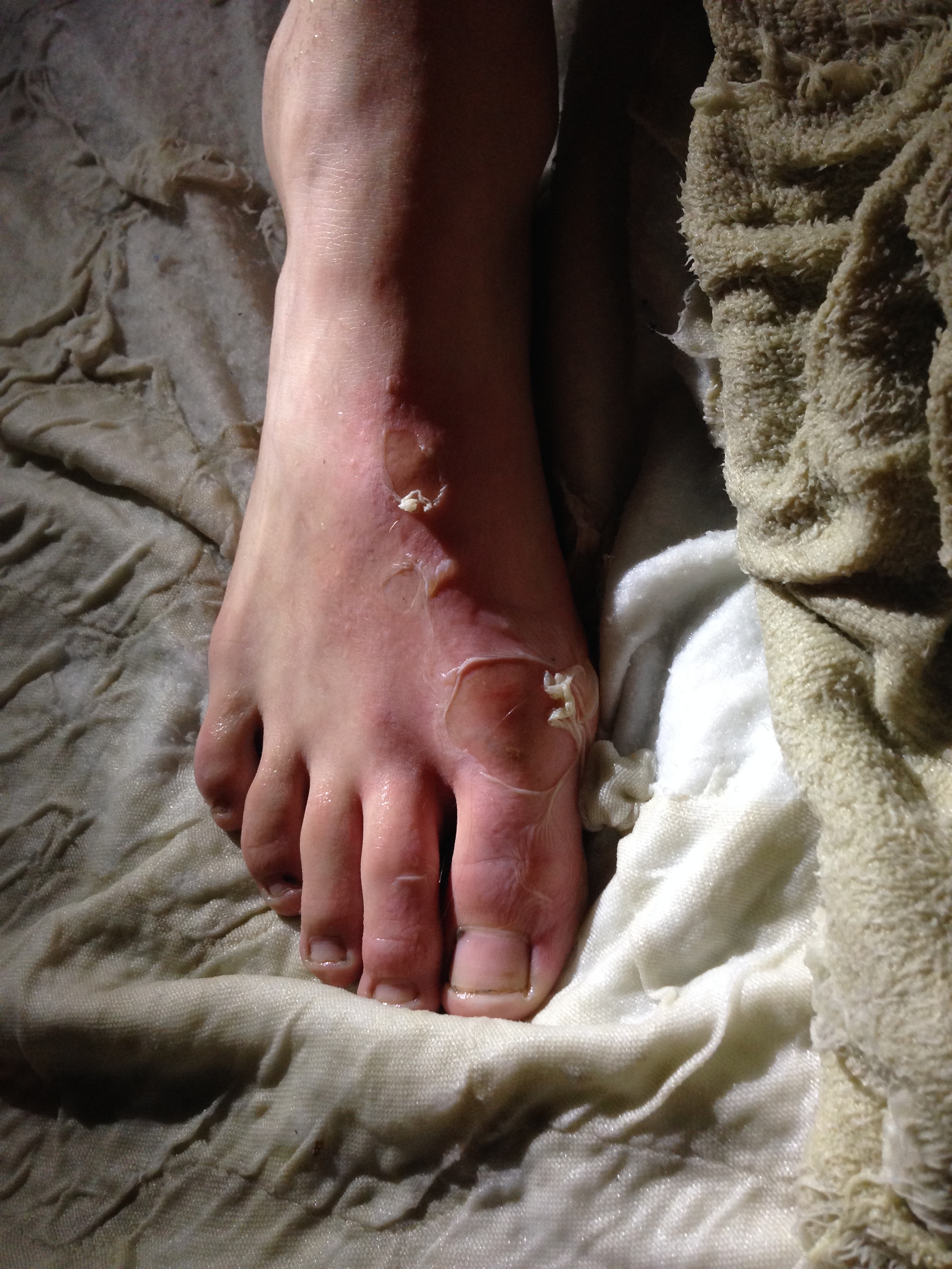 Badly Burned Foot of Amish Boy Before First Aid B & W Ointment